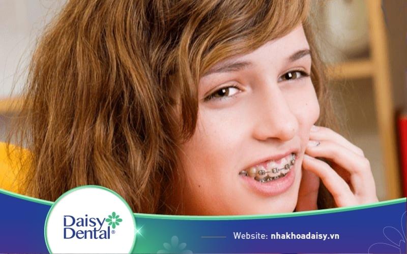 Niềng răng mắc cài tự buộc giá bao nhiêu? Có tốt không?