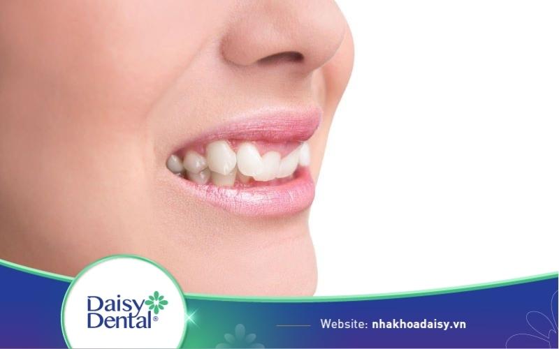 Răng không đều phải làm sao? Cách khắc phục hiệu quả nhất