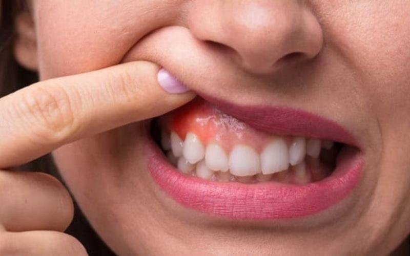 Viêm lợi là nguyên nhân khiến niềng răng bị hở lợi