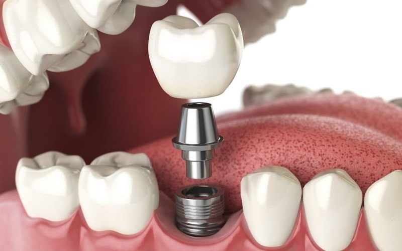 Cấy ghép implant là lựa chọn lý tưởng ở trường hợp mất răng vĩnh viễn do răng sâu