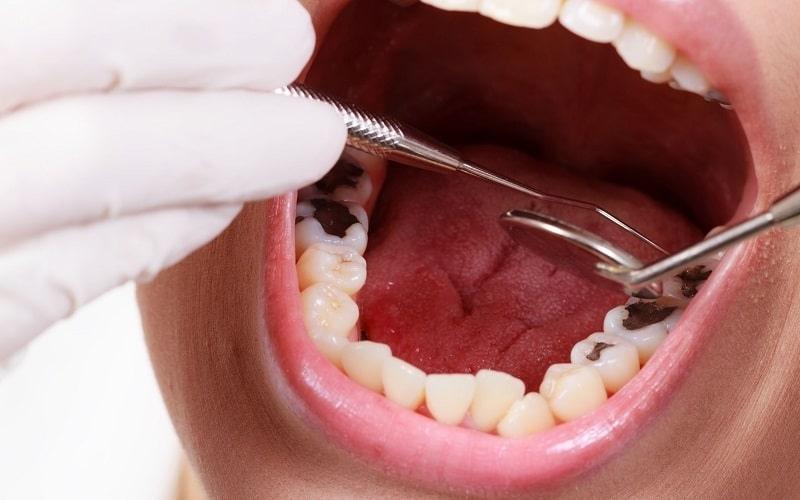 Nha sĩ tiến hành trám răng tại các lỗ hỏng do sâu răng