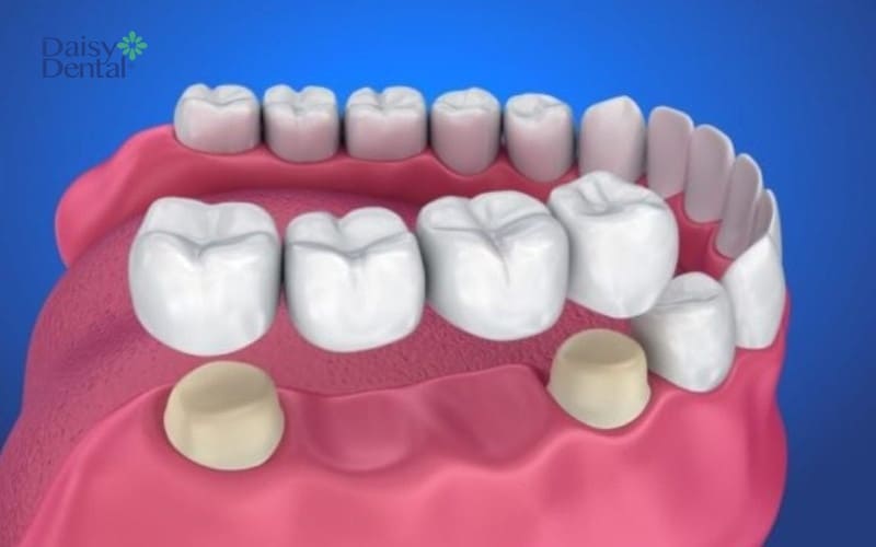 Bắc cầu răng sứ là kỹ thuật trồng răng hàm dưới được nhiều người lựa chọn
