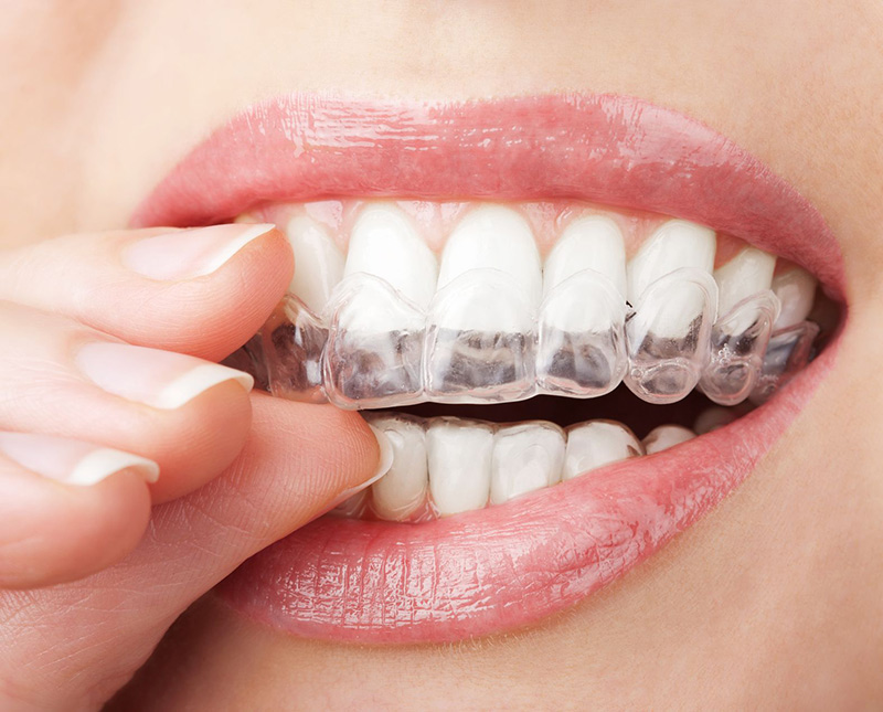 Giá niềng răng phụ thuộc vào tình trạng răng hàm và số khay niềng