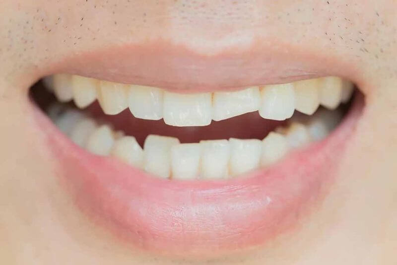 Răng bị sứt mẻ trở nên nhạy cảm hơn