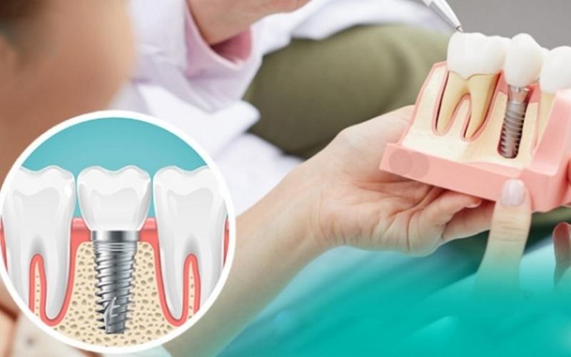 Trồng răng Implant là phương pháp phục hình răng tiên tiến nhất