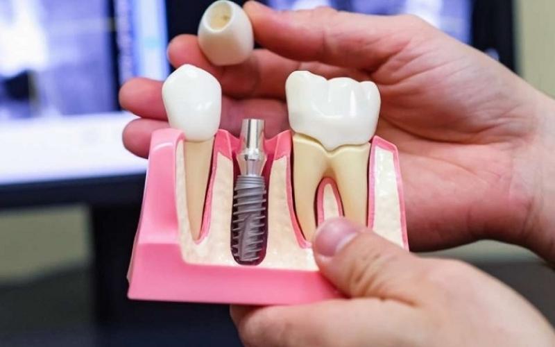 Phương pháp trồng răng implant có nhiều ưu điểm nổi bật