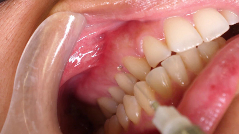 Bác sĩ tiến hành gây tê và xử lý bề mặt răng để tăng độ bám của lớp sứ Veneer