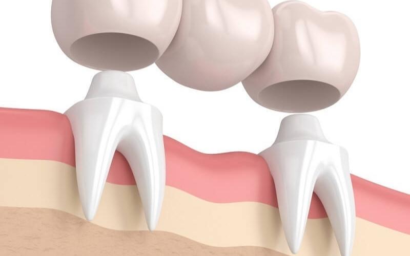 Cầu răng sứ giúp khắc phục tình trạng mất 1 răng ở vị trí bất kỳ