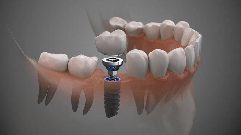 Chất lượng trụ trồng răng Implant là tiêu chí đánh giá địa chỉ trồng răng ở đâu tốt nhất