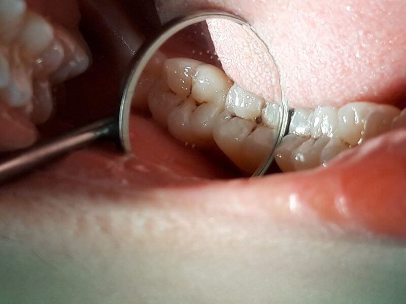Các đốm đen li ti xuất hiện trên bề mặt răng