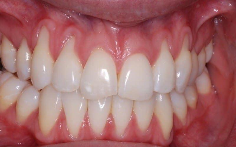 Trường hợp hở chân răng nhẹ, bác sĩ làm sạch bề mặt răng bằng phương pháp cạo vôi kết hợp với hướng dẫn vệ sinh răng miệng đúng cách