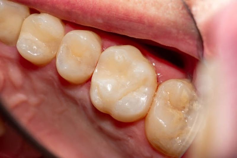 Răng cấm có mặt nhai rộng, nhiều hố rãnh và múi nên thức ăn thừa dễ bám vào