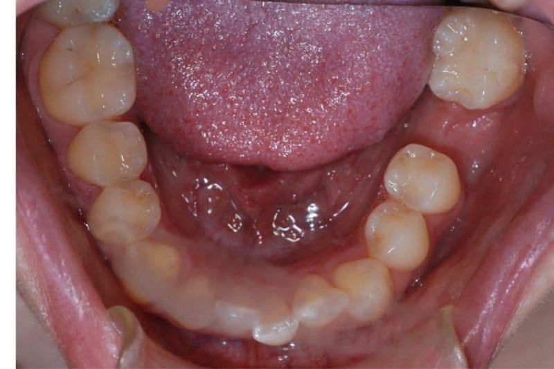 Mất răng cấm có thể gây tình trạng tiêu xương hàm và răng bị xô lệch