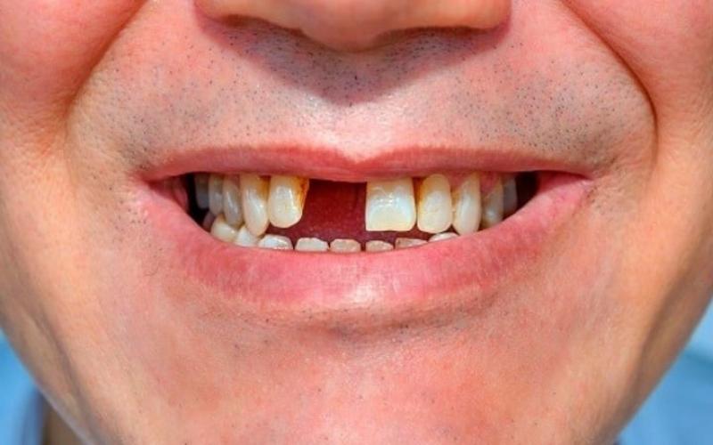 Tình trạng mất răng do nhiều nguyên nhân khác nhau gây nên