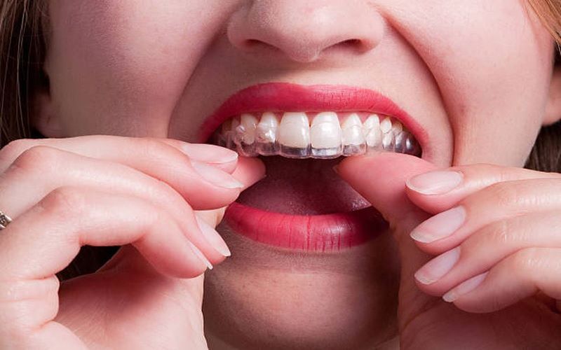 Niềng răng Invisalign có nhổ răng không còn tùy thuộc vào tình trạng răng miệng của khách hàng