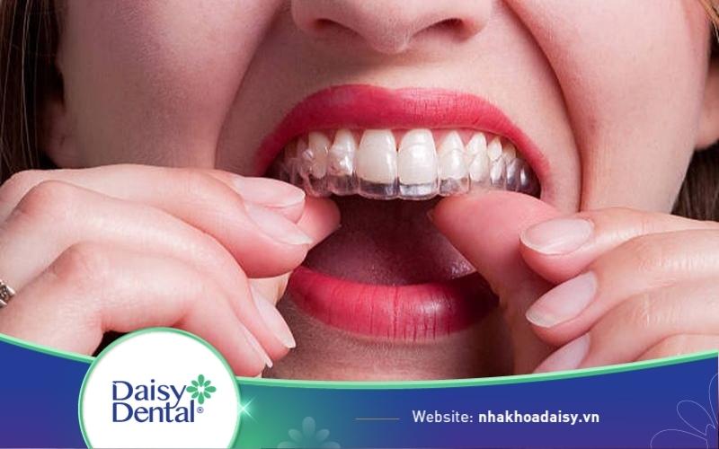 Niềng răng Invisalign có nhổ răng không