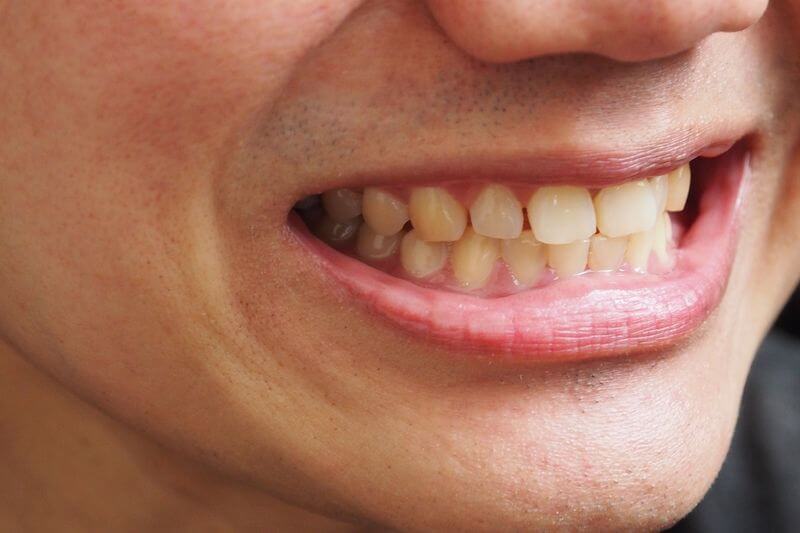 Răng bị xỉn màu không thể phục hồi bằng phương pháp tẩy trắng