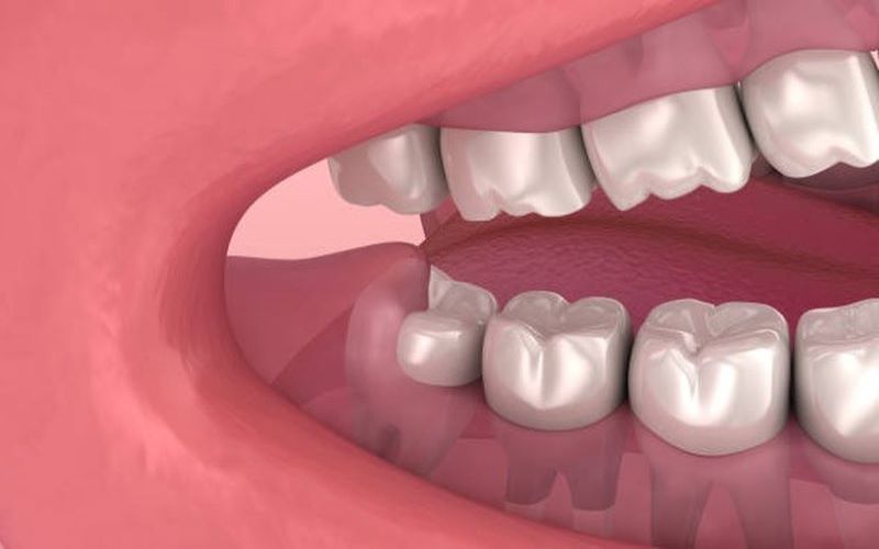 Răng khôn thường được ưu tiên nhổ khi niềng răng Invisalign