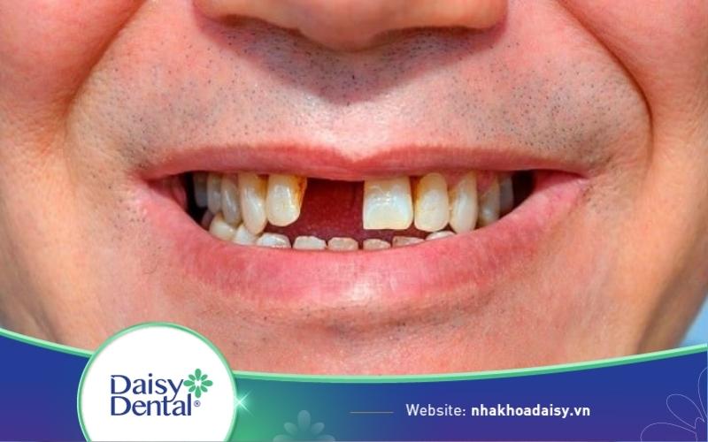 Mất răng có ảnh hưởng gì không? Bị mất răng phải làm sao?