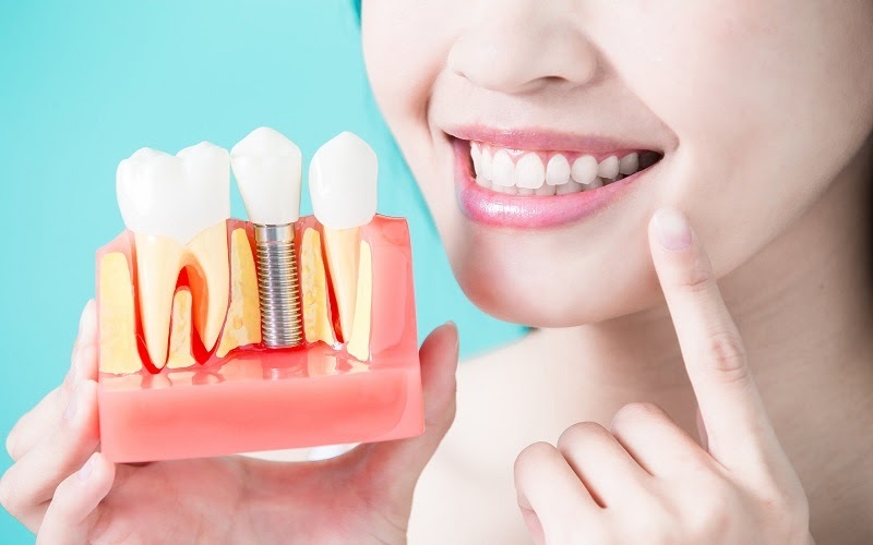 Cấy ghép Implant giải quyết tình trạng mất răng hiệu quả nhất