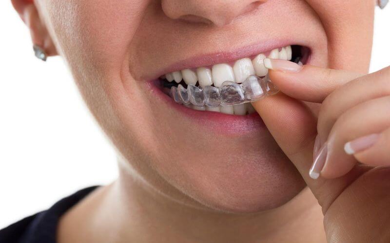 Niềng răng trong suốt ở người lớn thường kéo dài khoảng 1-2 năm