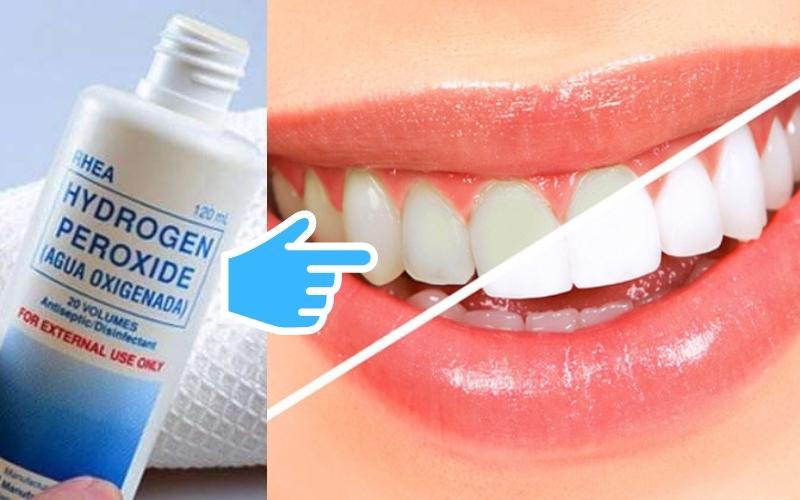 Công dụng của oxy già trong quá trình làm trắng răng