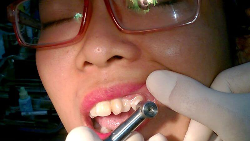 Đục lỗ trên răng có thể dễ dàng tích tụ mảng bám