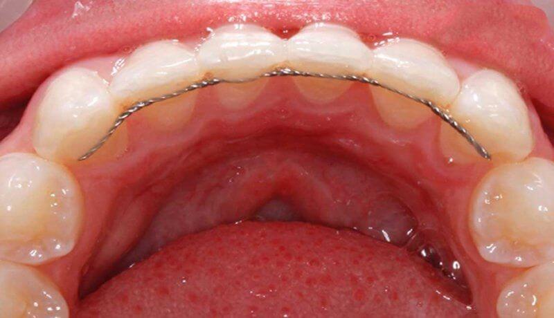 Loại hàm duy trì cố định giúp giảm thời gian đeo hàm sau khi niềng răng