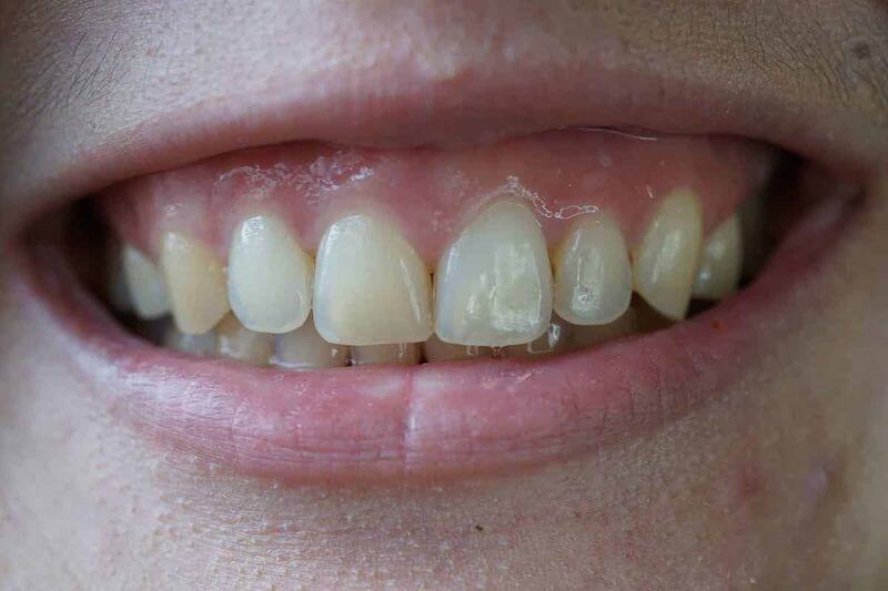 Cười hở lợi là tình trạng nướu răng bị lộ ra nhiều trong khi cười nói