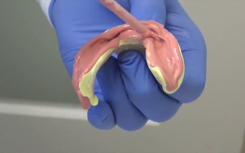 Bác sĩ dùng một loại silicon đặc biệt để lấy dấu răng của bệnh nhân