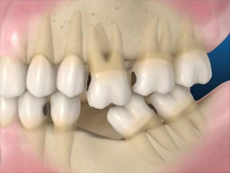 Mất răng trong thời gian dài dẫn đến tiêu xương và làm gò má cao