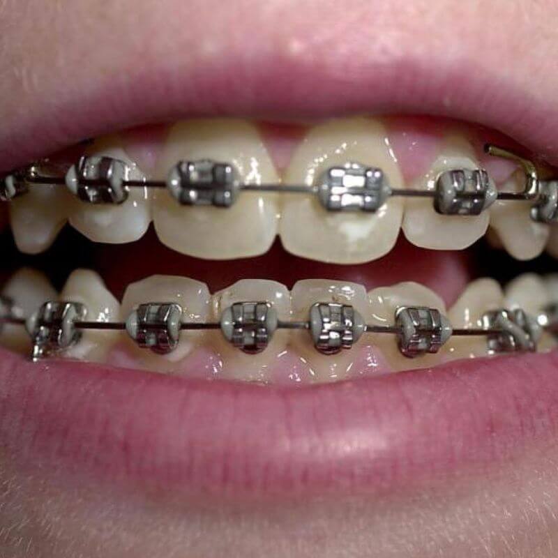 Niềng răng có làm răng yếu đi không phụ thuộc vào rất nhiều yếu tố