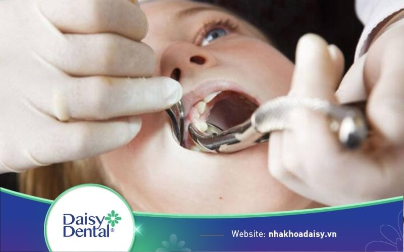 Niềng răng có phải nhổ răng không