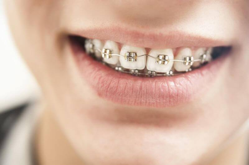 Niềng răng kiểu truyền thống hiệu quả nhất và thời gian niềng răng nhanh nhất trong tất cả các phương pháp chỉnh nha
