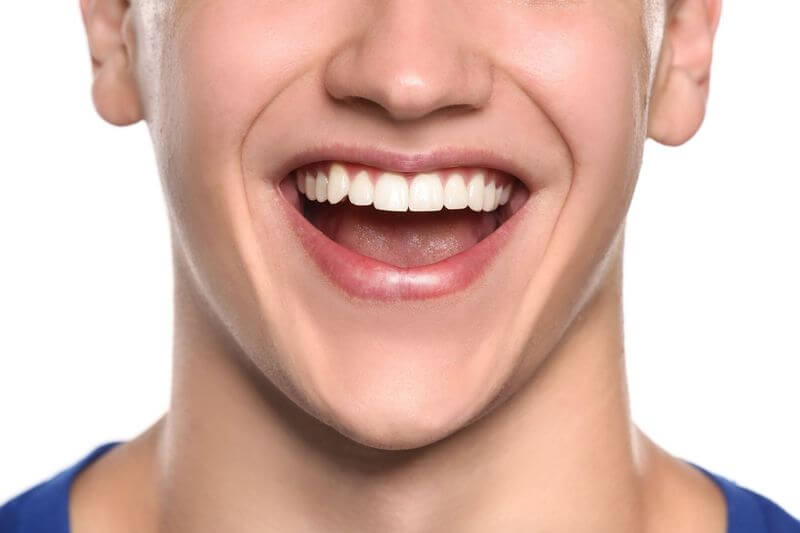 Niềng răng mang đến nụ cười đẹp cho người dùng