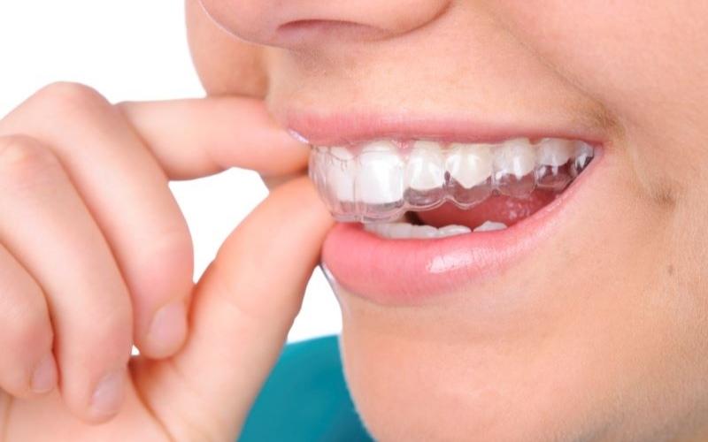 Phương pháp tẩy trắng răng bằng máng cho hiệu quả cao