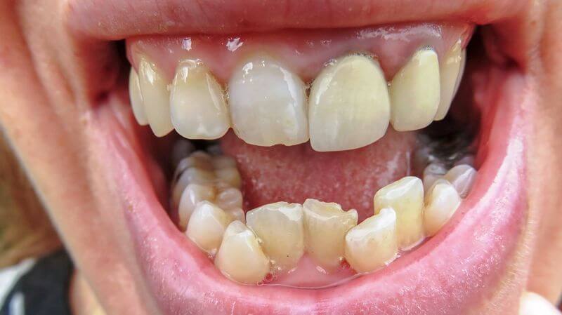 Trường hợp răng mọc chen chúc trên cung hàm