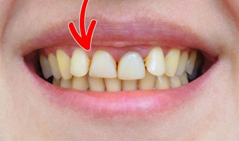Trường hợp răng bị ố vàng do dùng nhiều trà, cà phê, thuốc lá