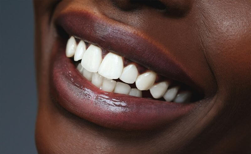 Tẩy trắng răng bằng công nghệ hiện đại giúp răng trắng sáng đến 99%