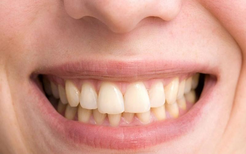Tẩy trắng răng tại nhà bằng máng thích hợp cho người có răng xỉn màu