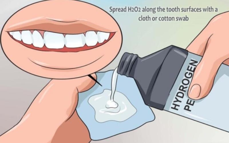 Thoa oxy già lên răng để làm sạch các vết ố vàng trên răng