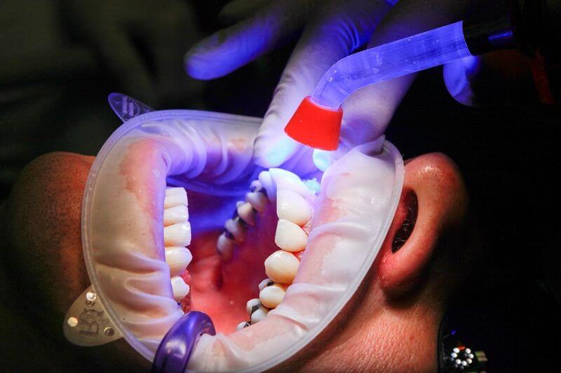 Thuốc tẩy trắng răng quyết định hiệu quả của quá trình tẩy trắng
