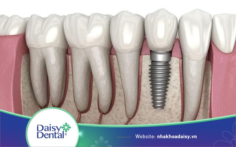 Trồng răng Implant Bình Dương