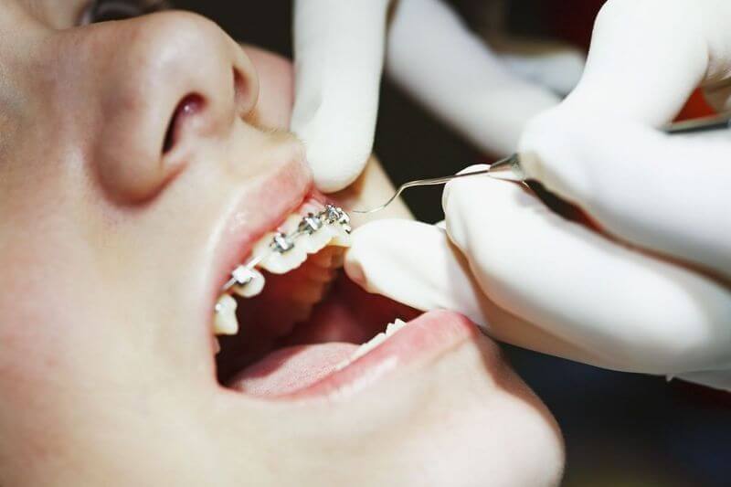 Nếu quá trình niềng răng hiệu quả tốt thì bạn hoàn toàn có thể tháo niềng răng sớm
