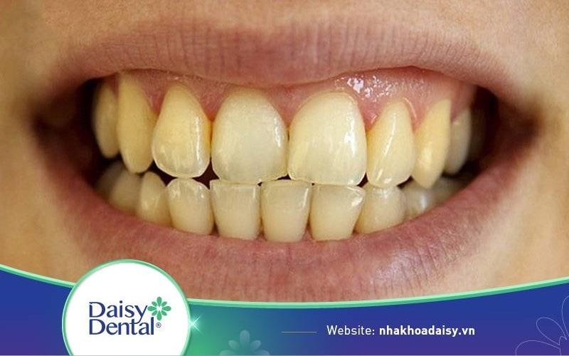 Răng ố vàng có tẩy trắng được không