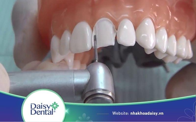 Mài răng bọc sứ hết bao nhiêu tiền