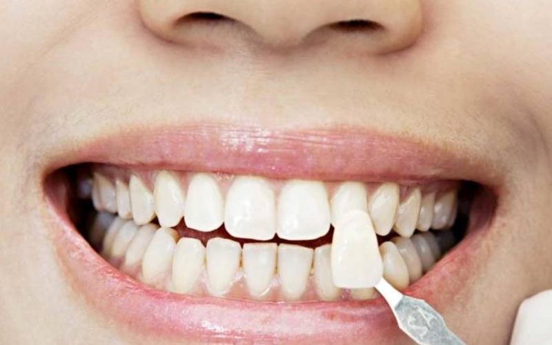 Bọc răng sứ 1 cái có được không?