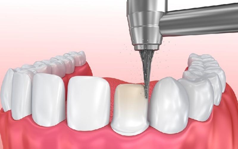 Bọc răng sứ có đau không sẽ phụ thuộc vào kỹ thuật mài cùi răng