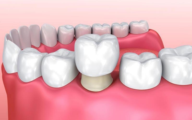 Bọc răng sứ là phương pháp mang lại vẻ đẹp thẩm mỹ và khắc phục khiếm khuyết răng miệng