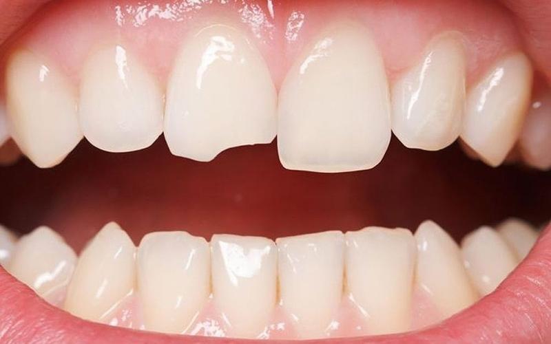 Để khắc phục răng mẻ, vỡ bạn nên bọc răng sứ